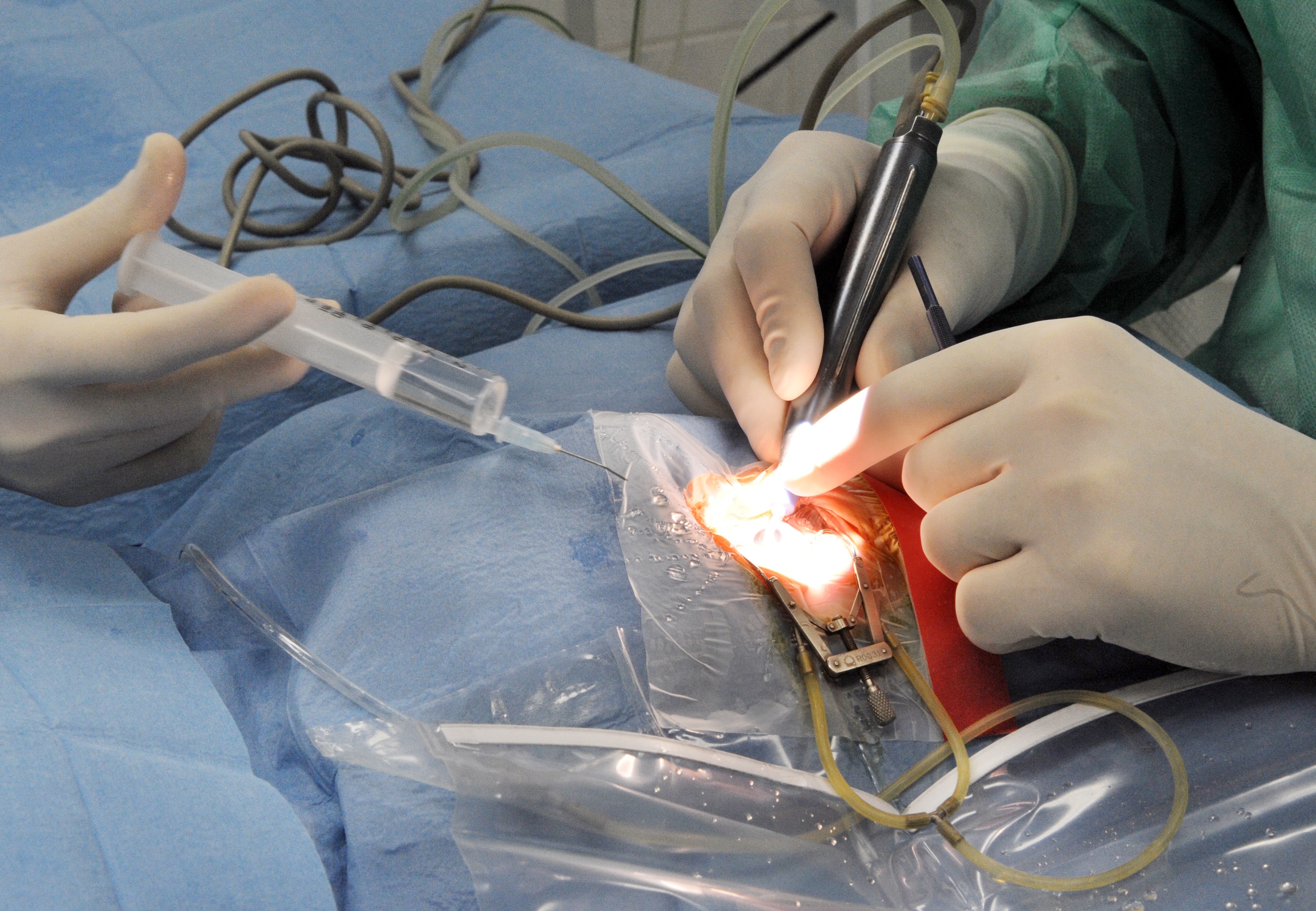 Lekárku, ktorá vyoperovala zlé oko, odsúdili. Nesmie tiež operovať a zaplatí odškodné