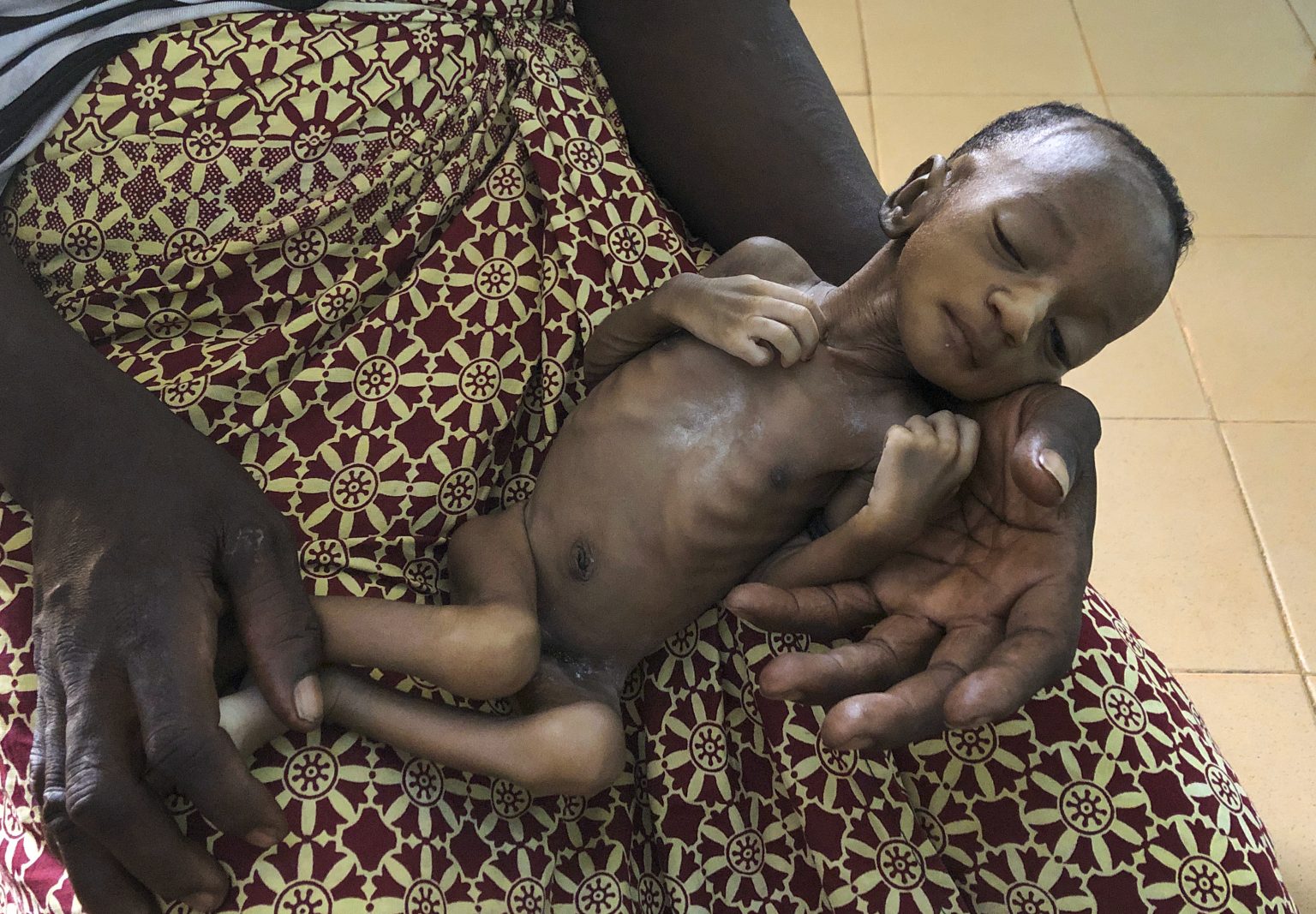 Na archívnej snímke z 11. júna 2020 matka drží svoje podvýživené dieťa v nemocnici v Burkina Faso. Foto: TASR/AP