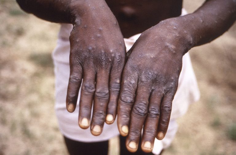 Afrika pre opičie kiahne vyhlásila stav núdze. Tento rok zaznamenali 15-tisíc prípadov