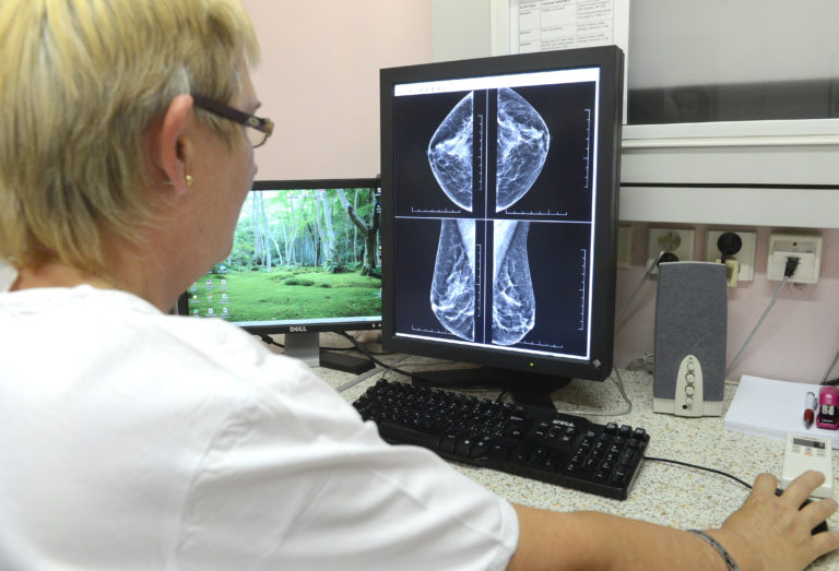 Samovyšetrenie nestačí. Rakovinu prsníka dokáže najúčinnejšie odhaliť mamografia