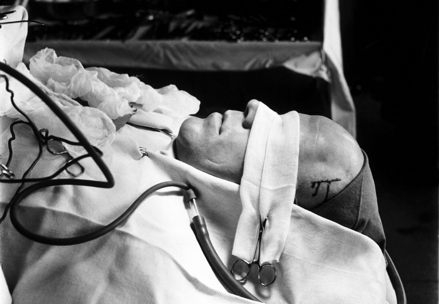 Pacient pripravený na lobotomický zákrok v roku 1949 v Štokholme. Foto: Profimedia.sk