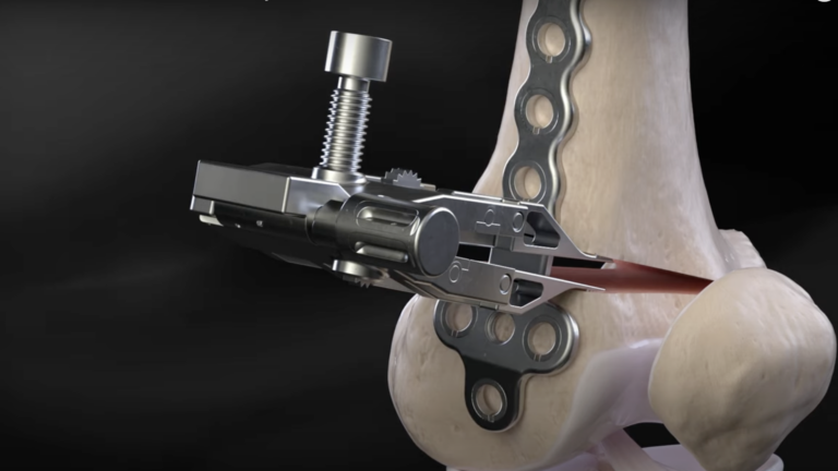 Svet má nový módny trend: Ľudia si predlžujú kosti