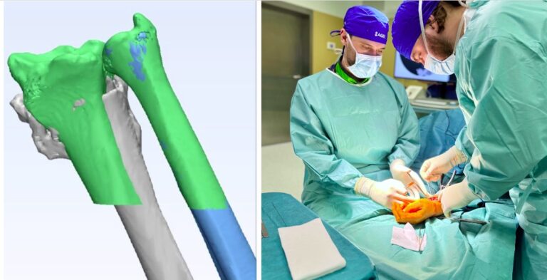 Revolučná technológia v ortopédii: Korekcia kostnej deformity pomocou 3D plánovania
