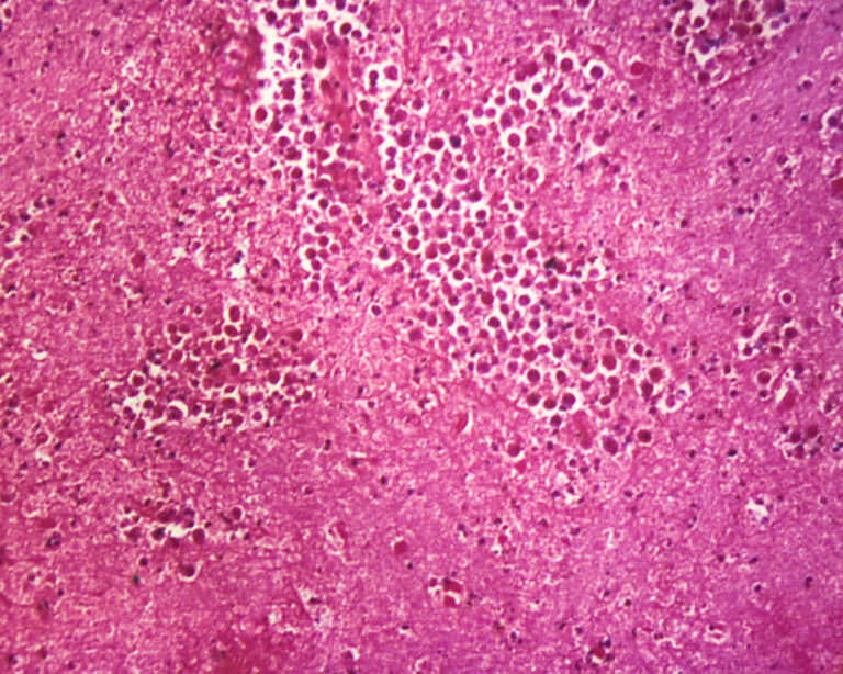 Pri zväčšení 125x táto fotomikrografia vzorky mozgového tkaniva zobrazuje cytoarchitektonické zmeny spojené s voľne žijúcou amébovou infekciou Naegleria fowleri. Foto: Smith Collection/Gado/Getty Images