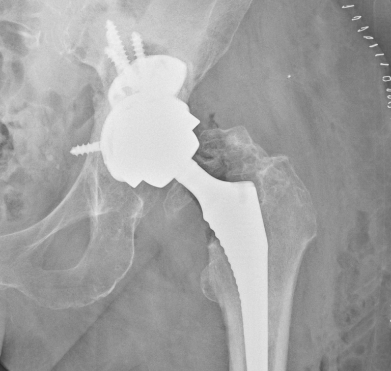 Bratislavskí lekári ako prví na Slovensku vykonali revolučnú operáciu kĺbu