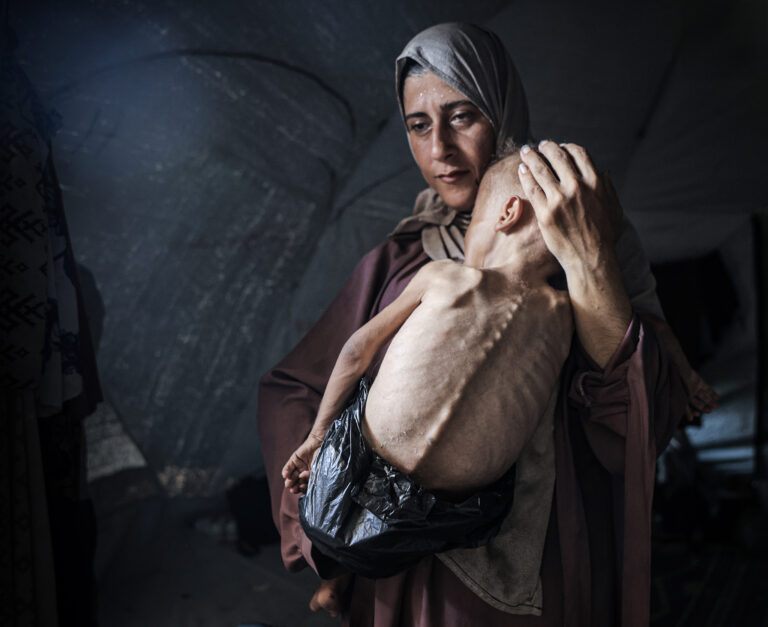 Unterernährtes Kleinkind in Gaza kämpft um sein Leben. Foto: Ahmed Jihad Ibrahim Al-arini/Anadolu via Getty Images