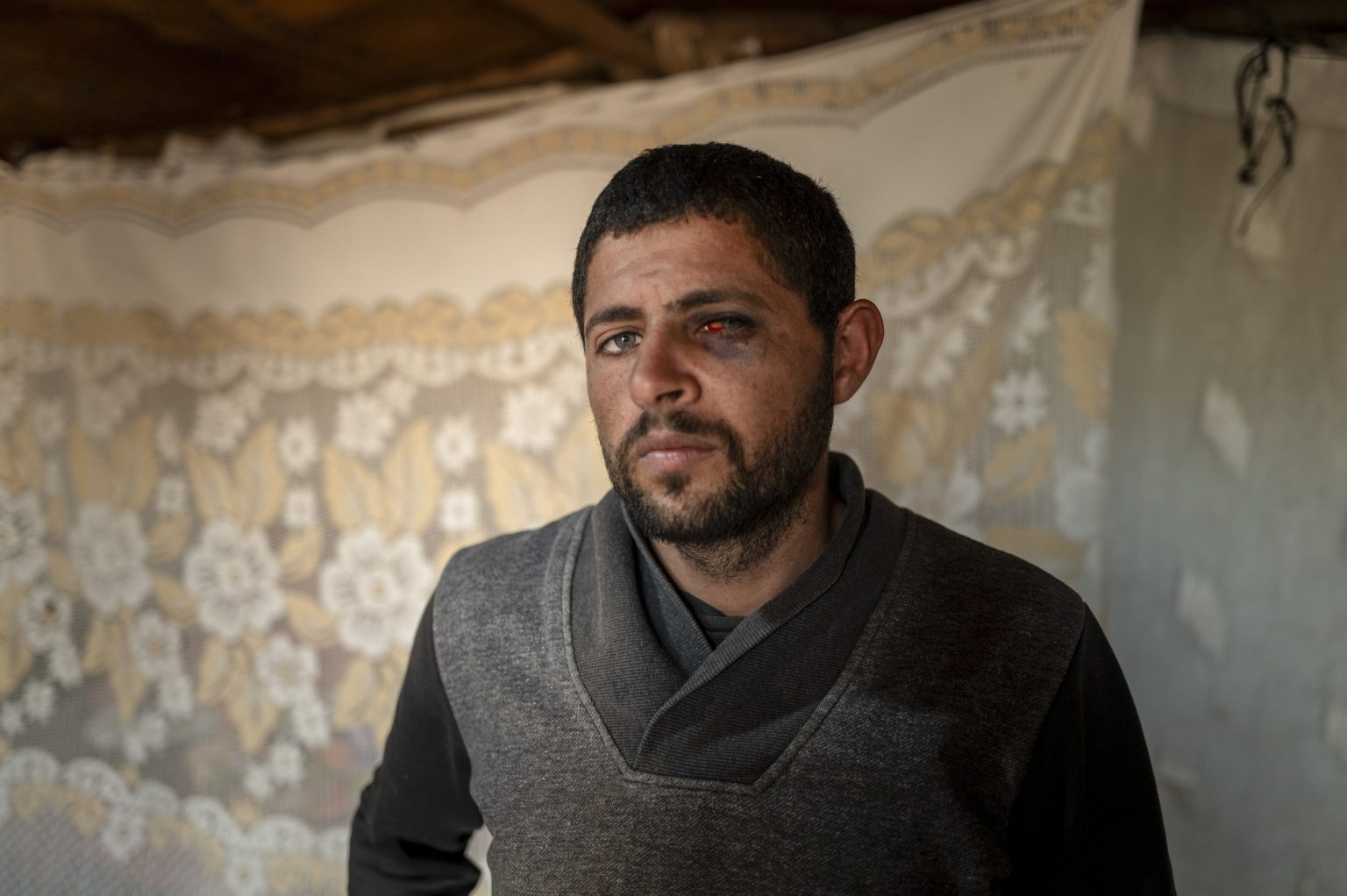 Suhaib Abú al-Kibáš s poraneným okom v osade Khirbet Humsa na Západnom brehu Jordánu. Foto: Afif Amireh/New York Times