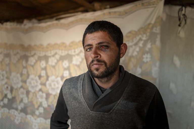 Suhaib Abú al-Kibáš s poraneným okom v osade Khirbet Humsa na Západnom brehu Jordánu. Foto: Afif Amireh/New York Times